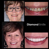 Diamond Smile hampaiden valkaisukokemus - Nainen ennen ja jälkeen kuvan valkoisista hampaista