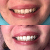 Diamond Smile tulos kokemus aktiivihiili hampaiden valkaisuun nauhat