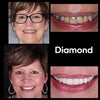 Diamond Smile hampaiden valkaisukokemus - Nainen ennen ja jälkeen kuvan valkoisista hampaista