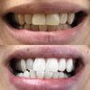 Koe Ennen ja jälkeen kuvat PAP+ hampaiden valkaisuliuskojen valkaisusta Diamond Smile -yhtiöltä.