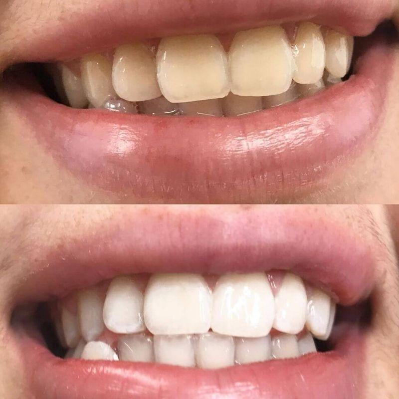 Ennen ja jälkeen kuvat PAP+ hampaiden valkaisusarjasta Diamond Smile