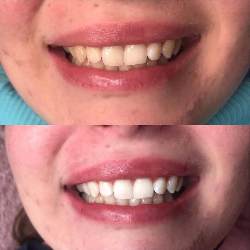 Ennen ja jälkeen kuvat PAP+ hampaiden valkaisusarjasta Diamond Smile