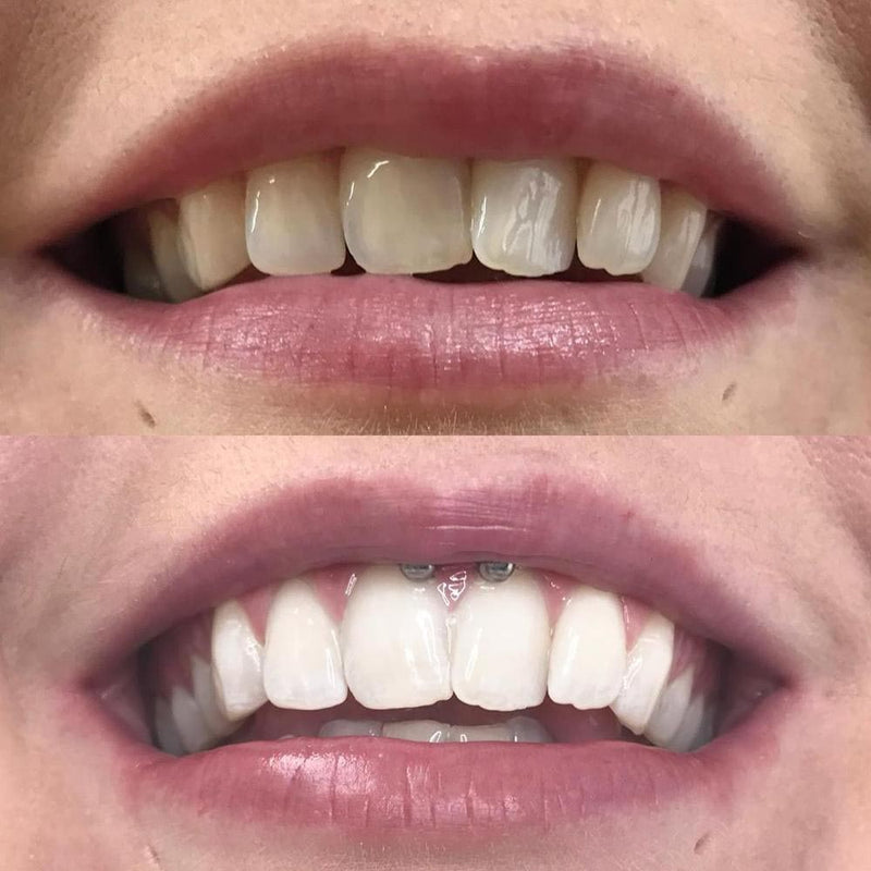 Whitening Suuvesi iD+
