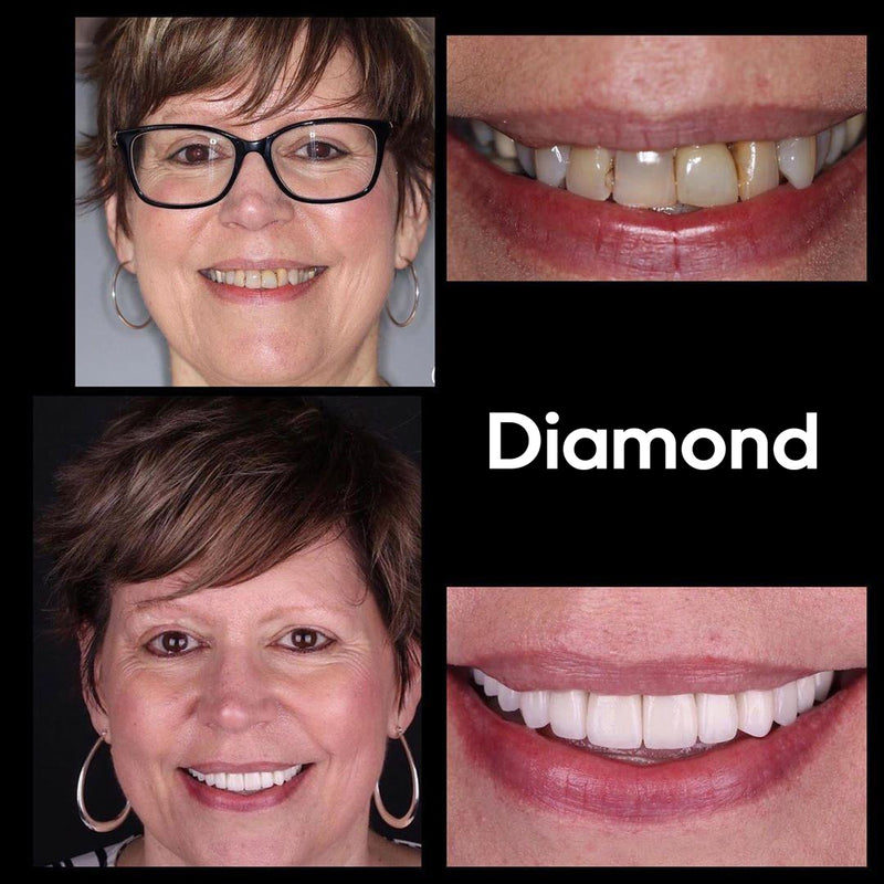 Diamond Smile hampaiden valkaisukokemus - Nainen ennen ja jälkeen kuvan valkoisista hampaista