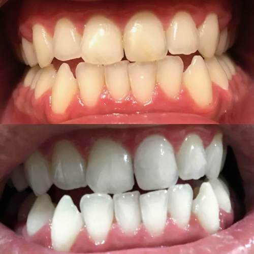Kokemuksia Diamond Smile hampaiden valkaisukynästä - ennen ja jälkeen kuva valkoisista hampaista